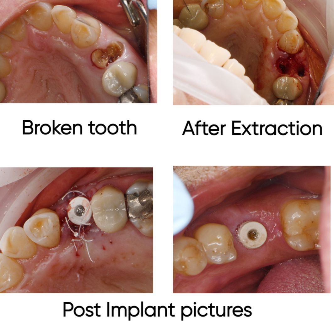 Four pictures of a broken tooth after extraction and post implant pictures