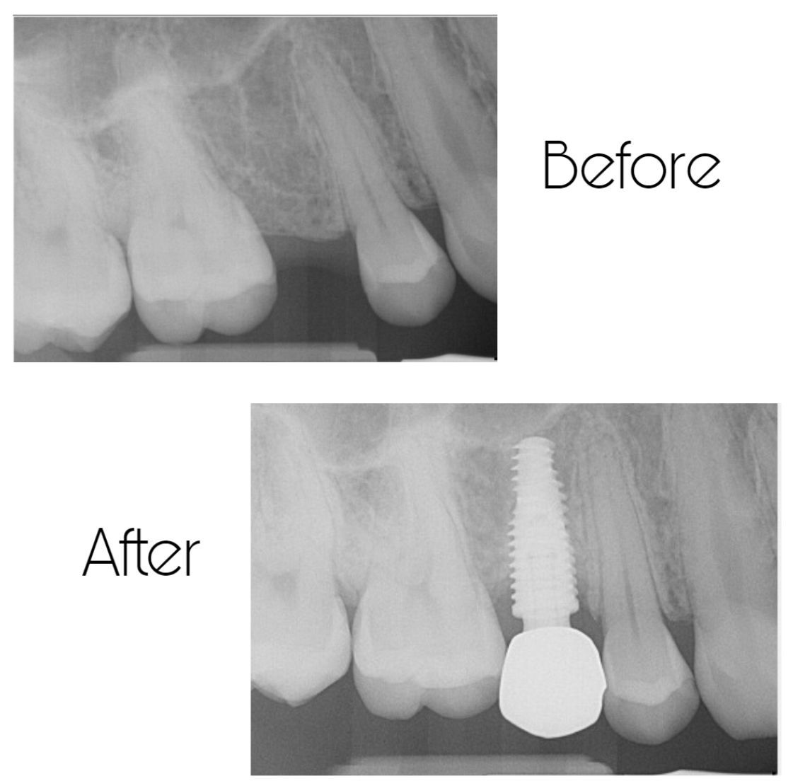 An x-ray of a person 's teeth before and after a dental implant