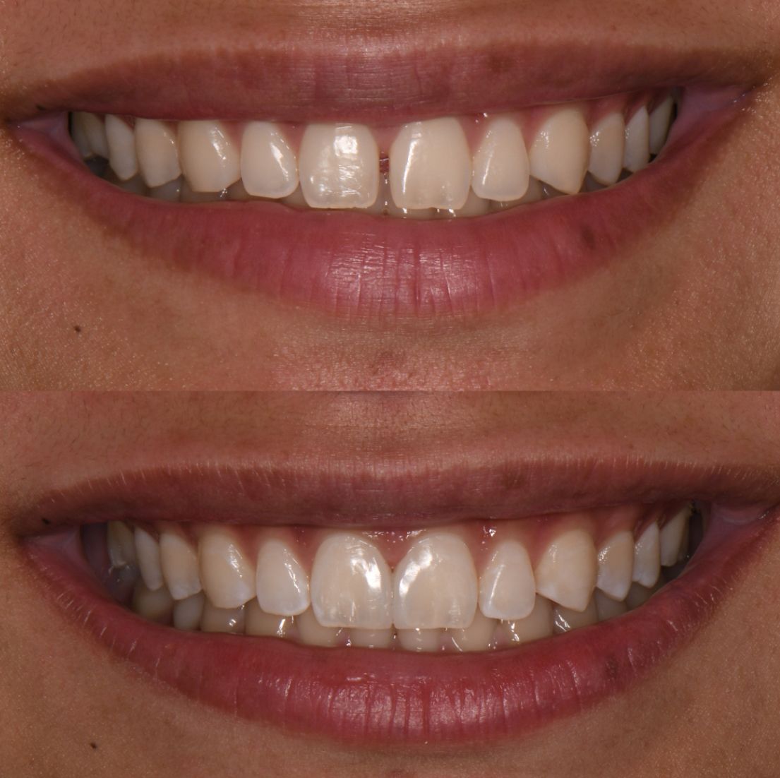 A before and after picture of a woman 's teeth.