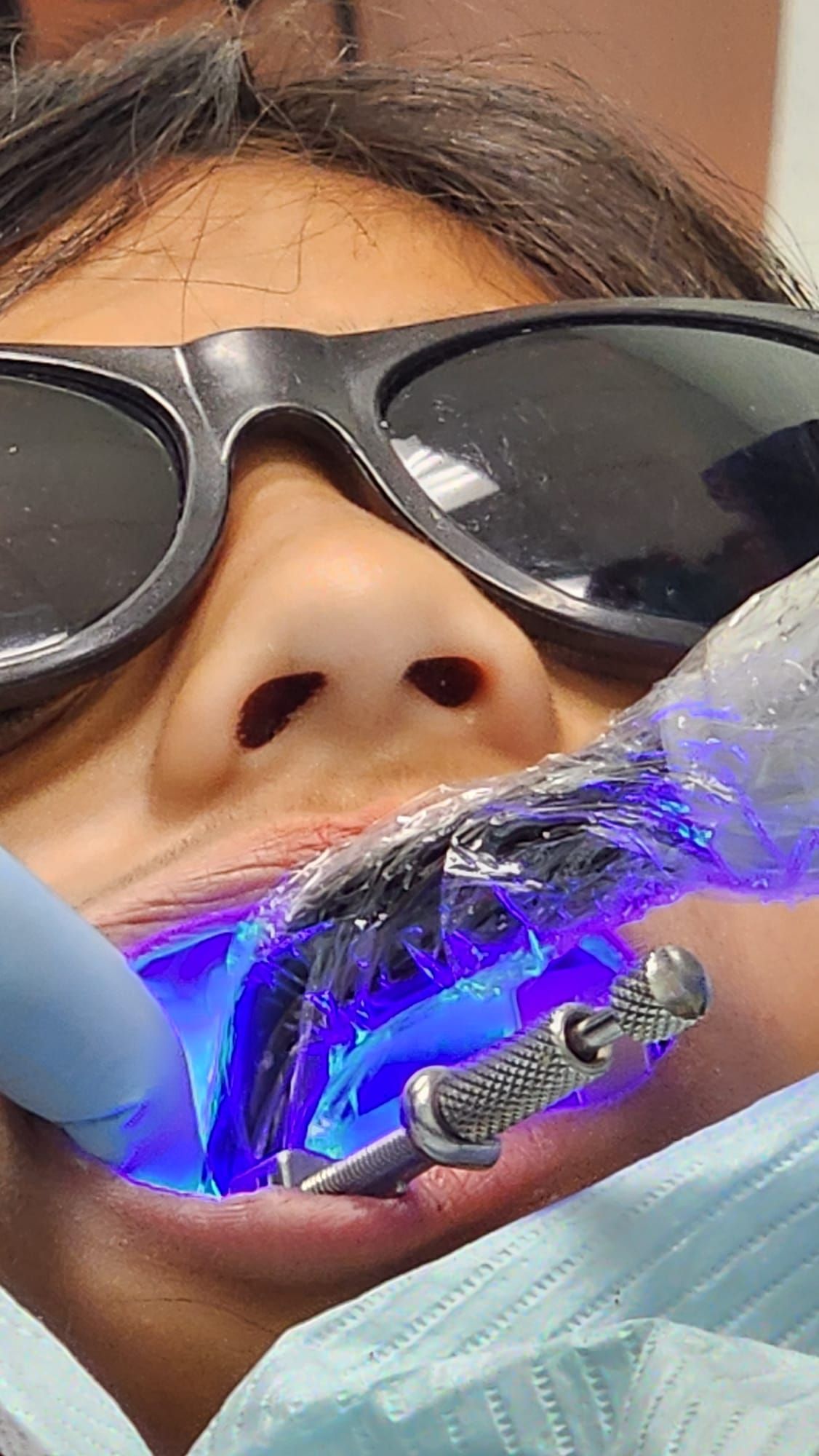 A woman wearing sunglasses is getting her teeth whitened by a dentist.