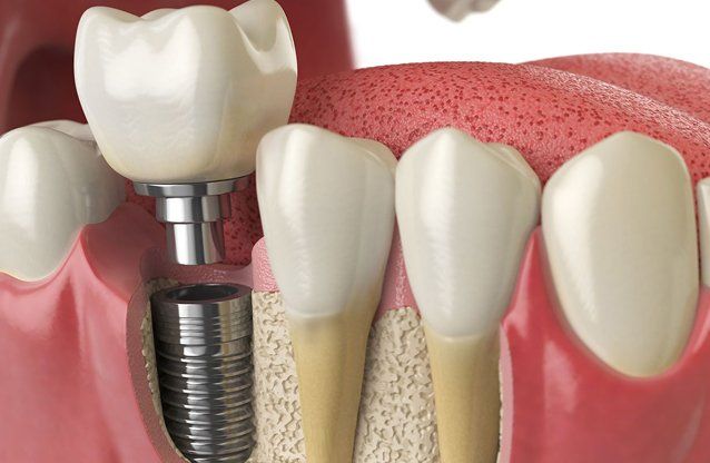 Learn More About Dental Implants Perfect smile