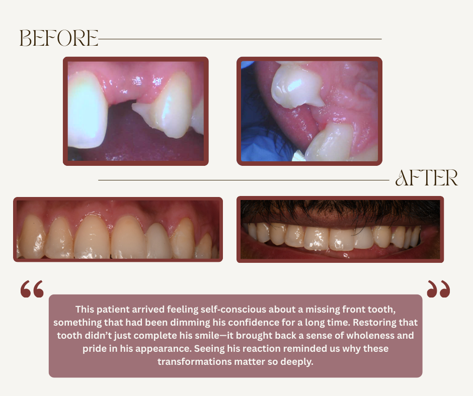 Before and after photos of dental treatment for a missing tooth, showing a restored, complete smile.