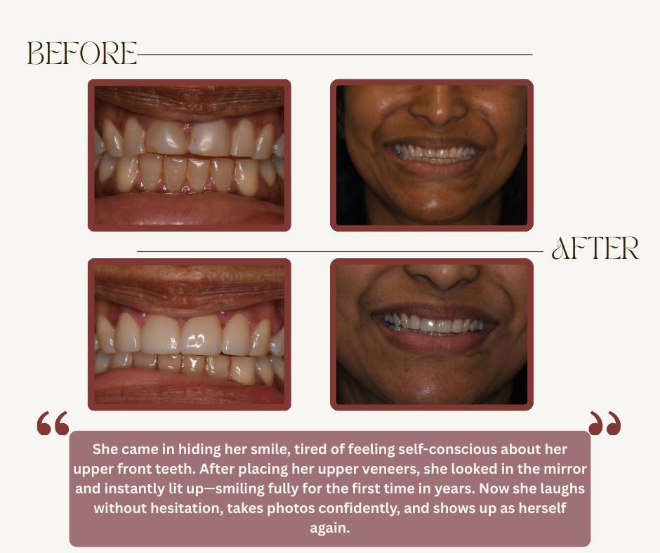 Before and after comparison of a patient's smile following dental veneer treatment, with a testimonial about her results.