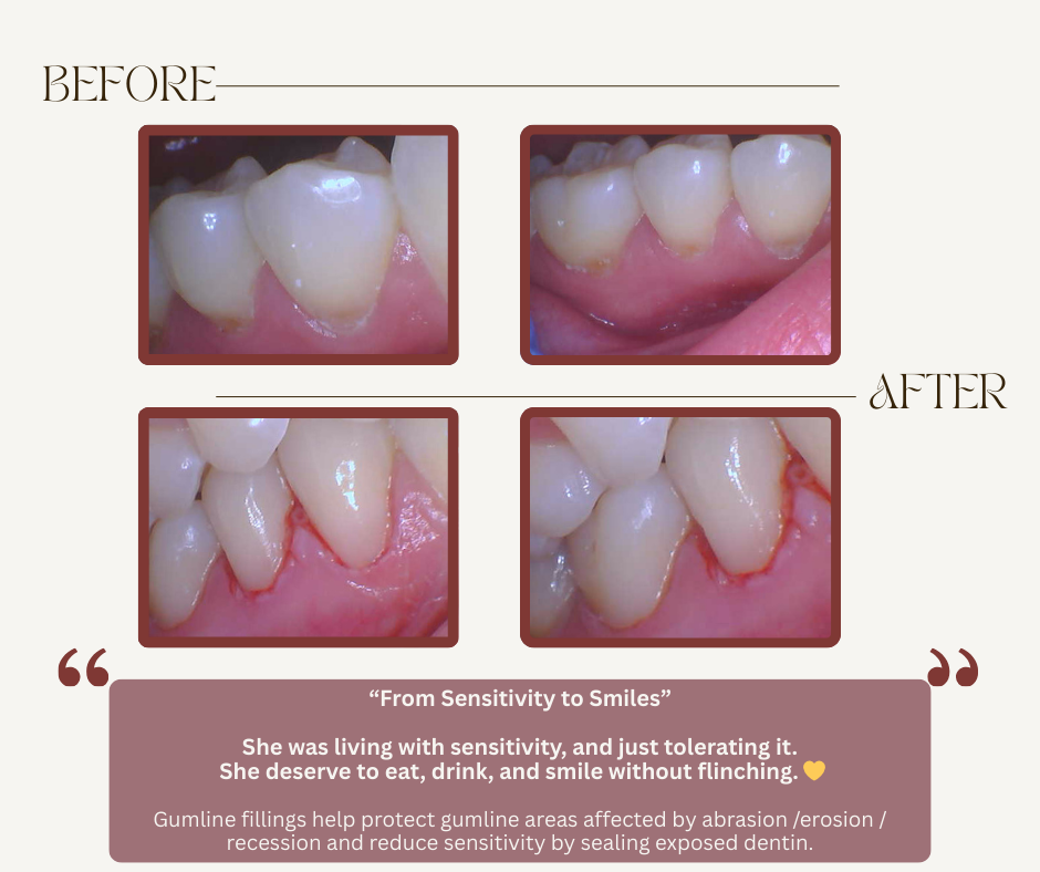 Before and after photos of dental gumline fillings, showing restored tooth enamel and reduced gum recession.