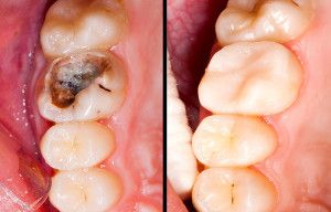 Damaged tooth restored back to health