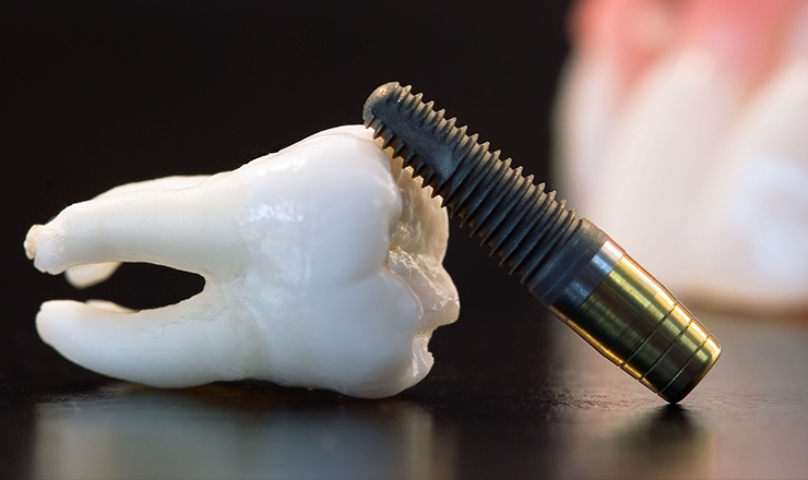 Dental Implants