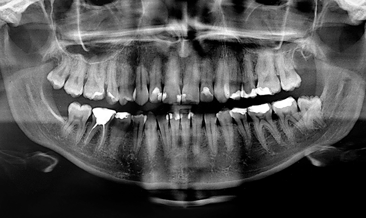 Dental X-Rays