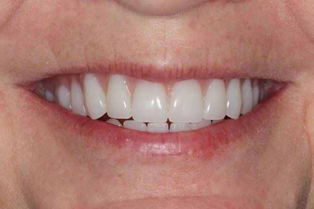 Dentures