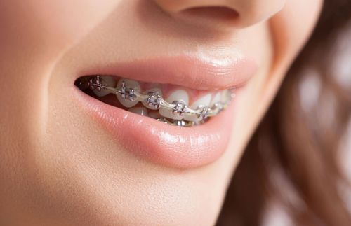 Close-up of a smiling mouth with clear braces and metal brackets on the teeth