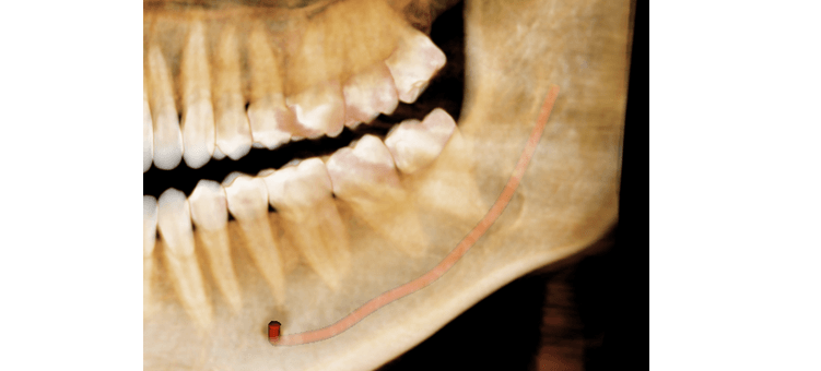 Panoramic view of a 3D CBCT scan tracing the path of the inferior alveolar nerve around the roots of teeth on the lower jaw and exiting the mental foramen.