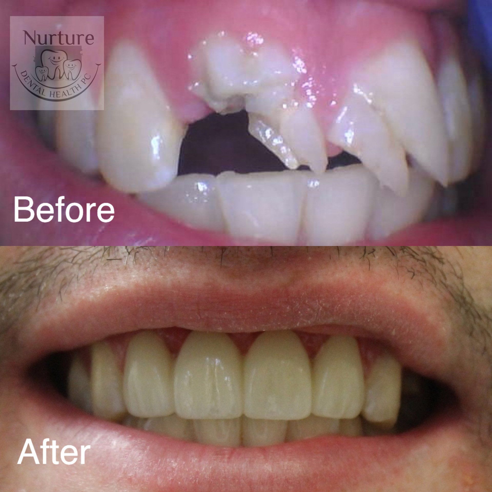 Before and after bridge to replace traumatized and broken teeth.