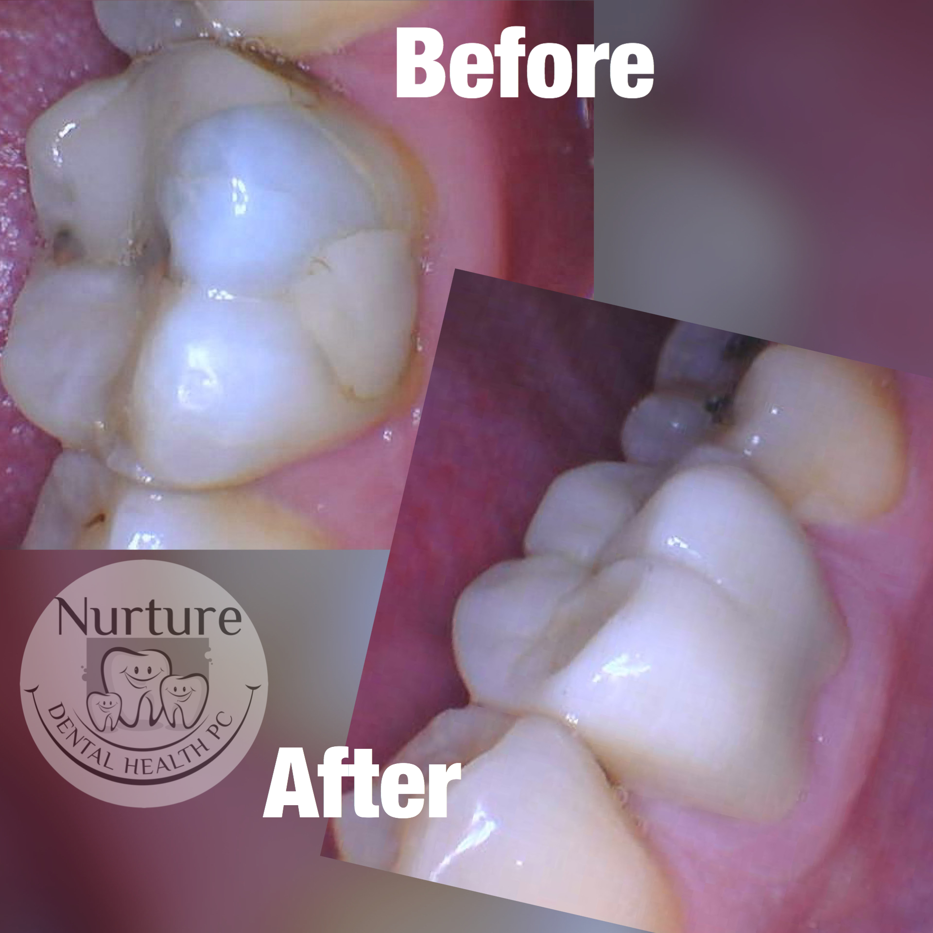Before and after crowns that cover over top of the tooth to provide a stronger, longer lasting restoration of tooth structure than large fillings which tend to break and need to be replaced frequently.