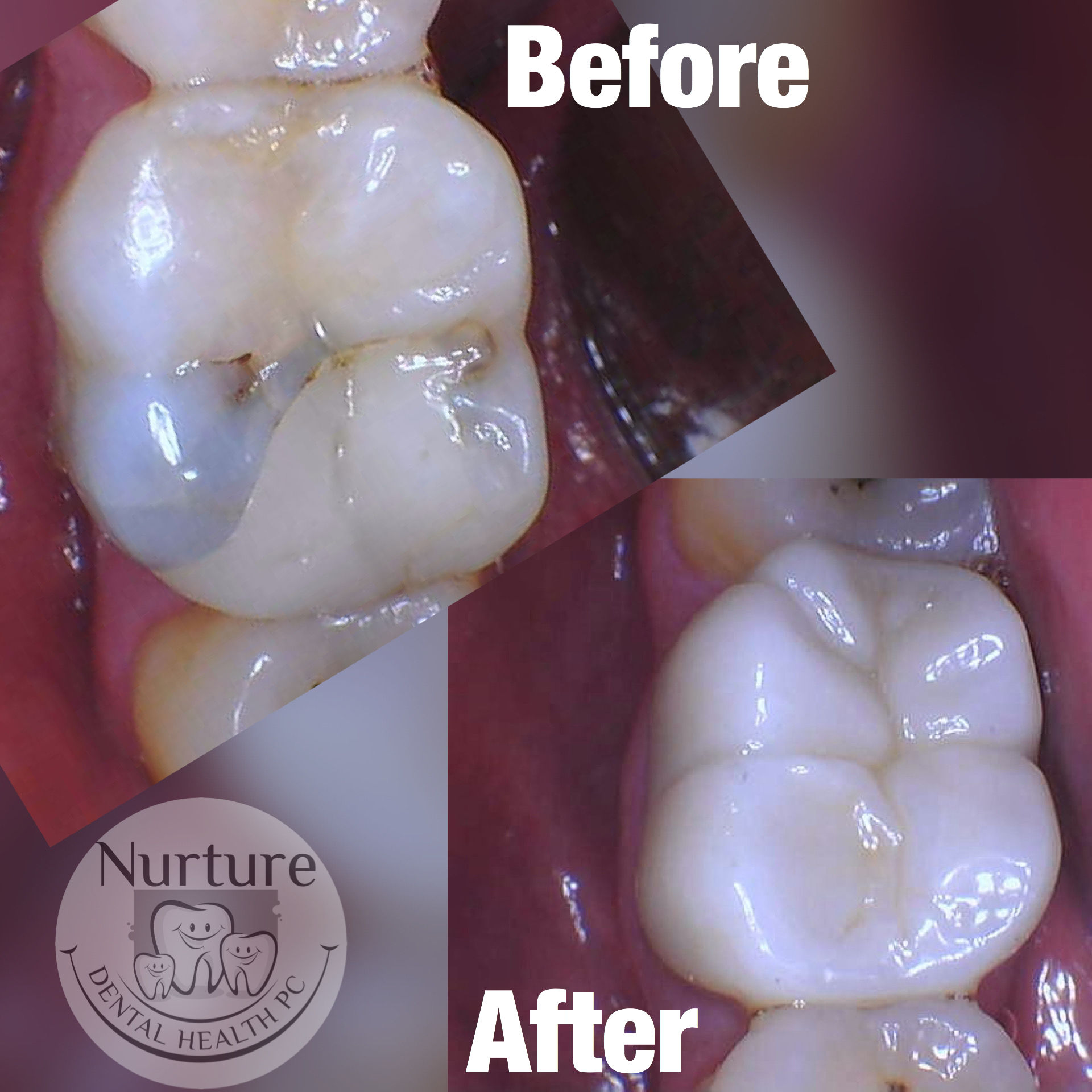 Before and after crowns for teeth.