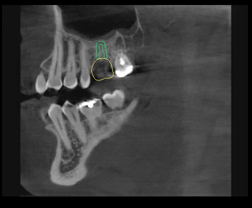3D CBCT cross section of planned implant for an upper molar.