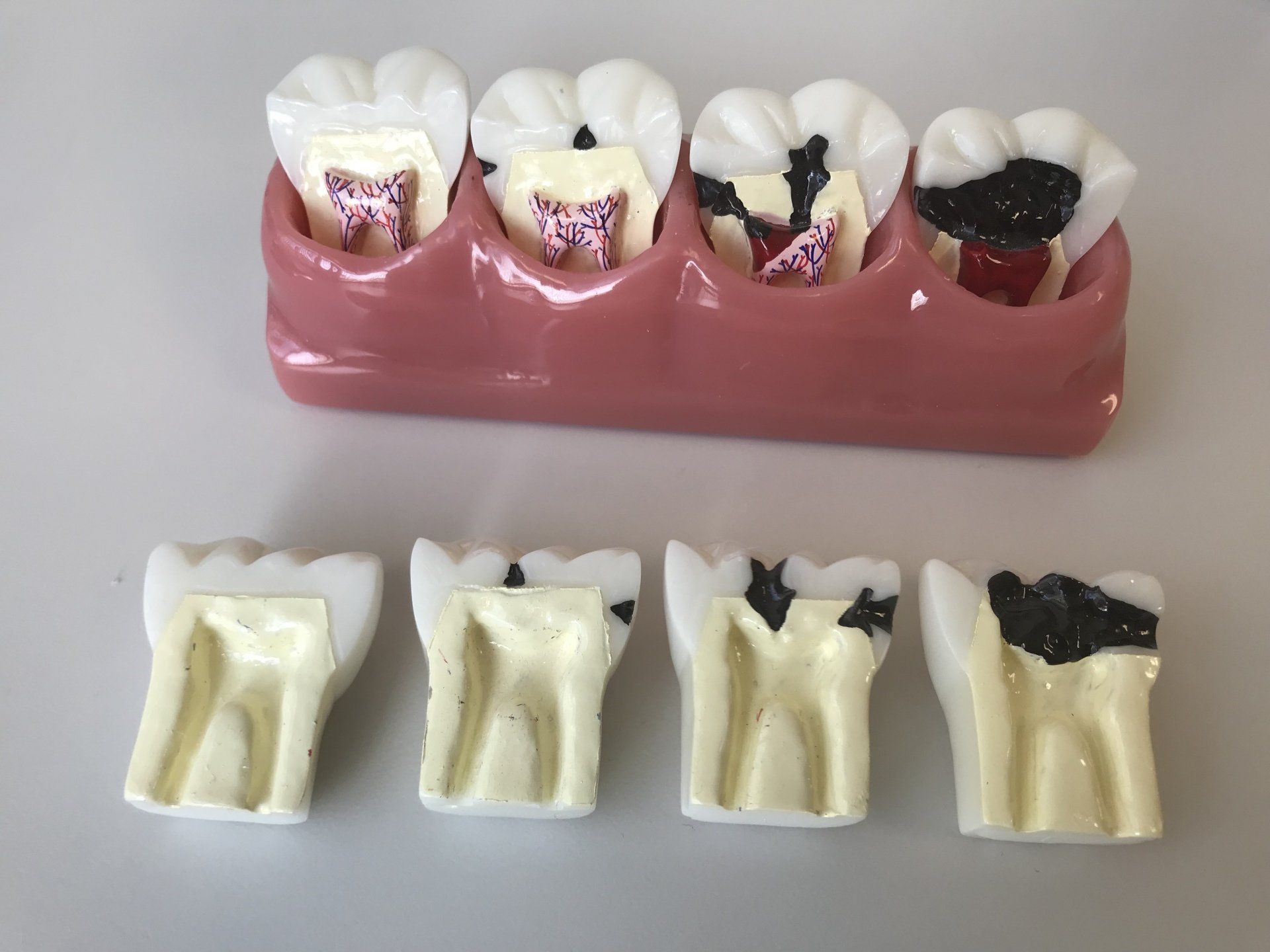 Dental Models showing caries progression into the nerve of the center of the tooth.