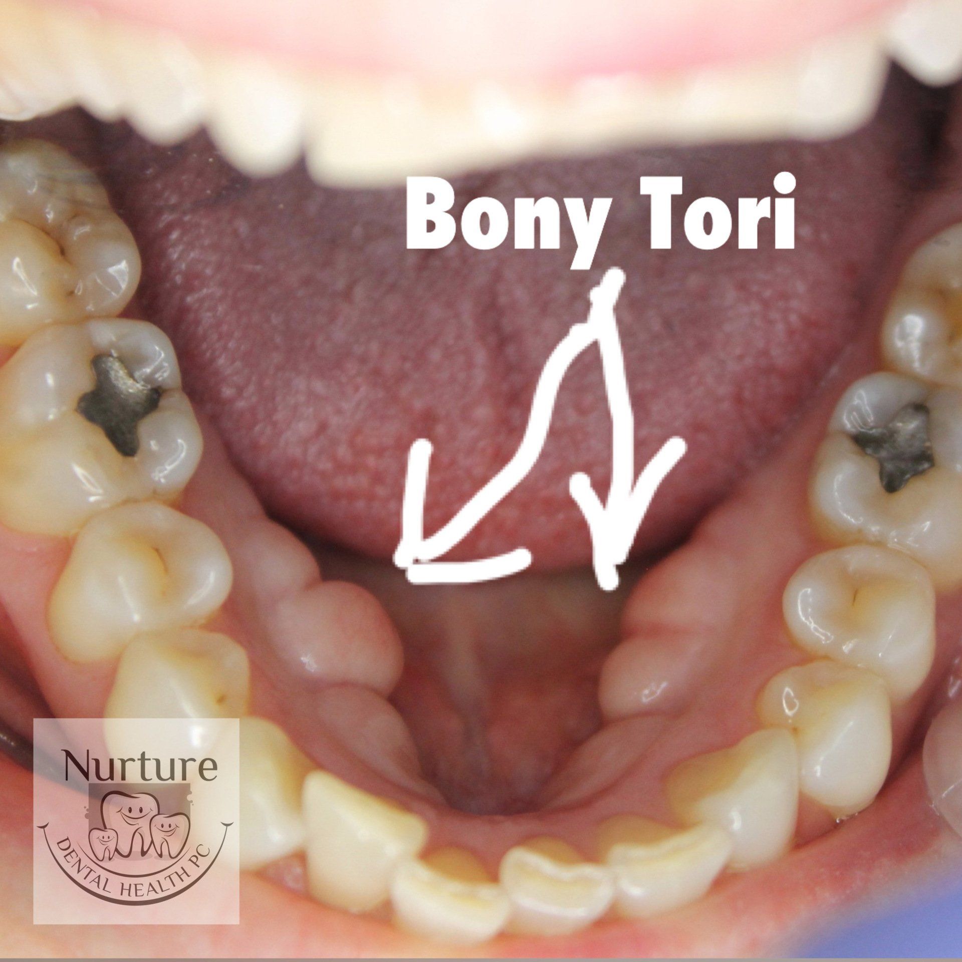 Lower lingual bony tori on mandible