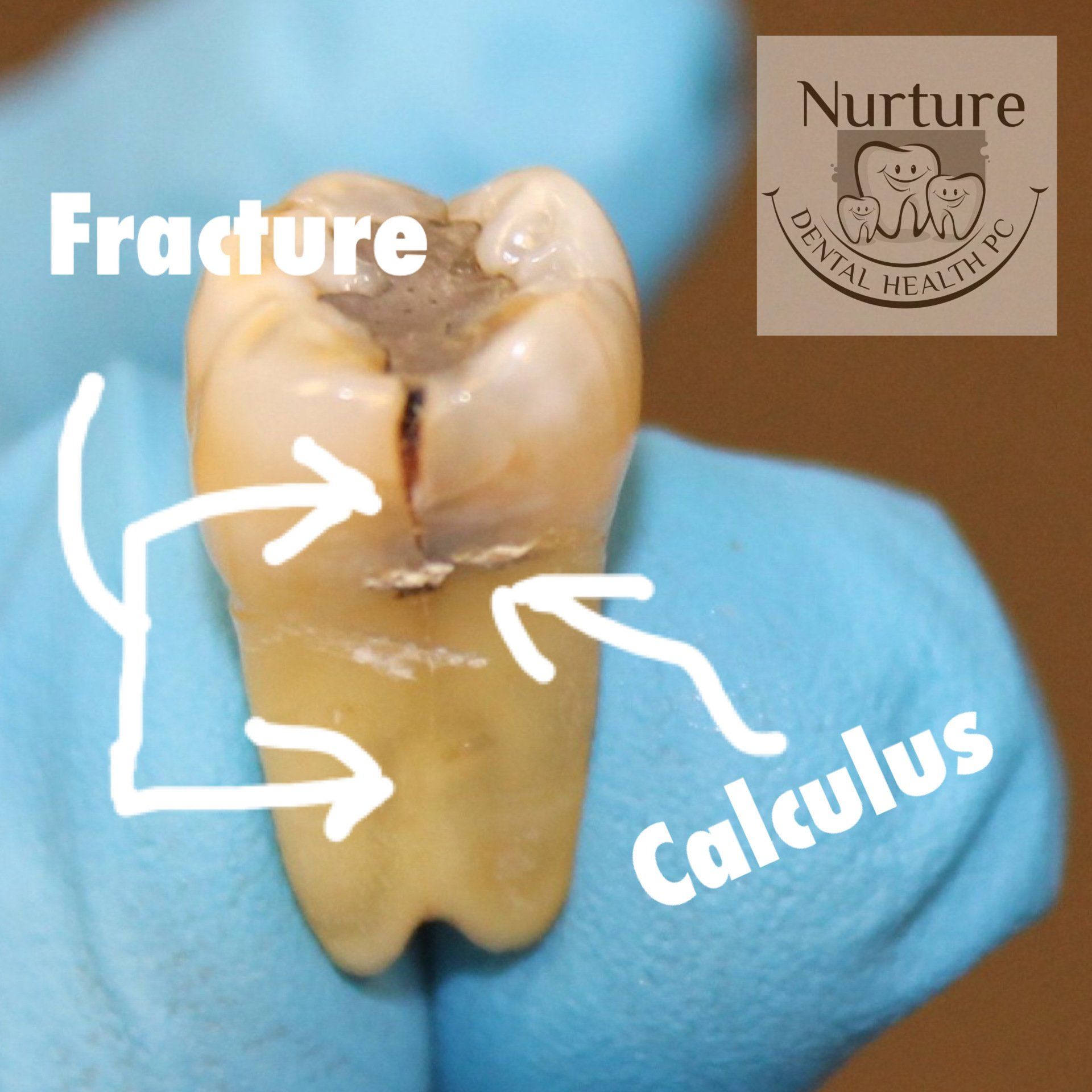 Fractured tooth that propagated down the root of the tooth with subgingival calculus attached to the root surface.