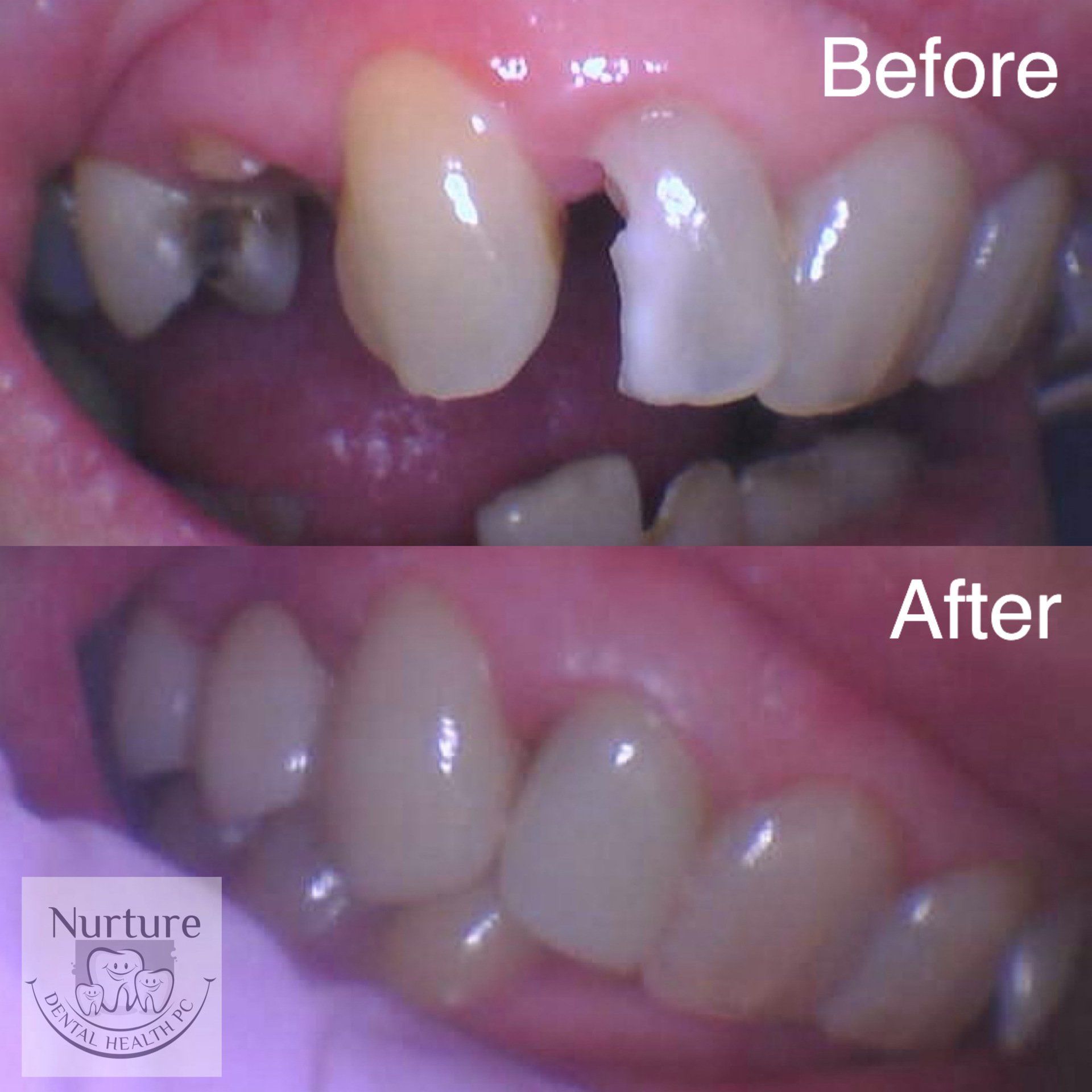 Before and after crown and bridge to replace missing teeth.