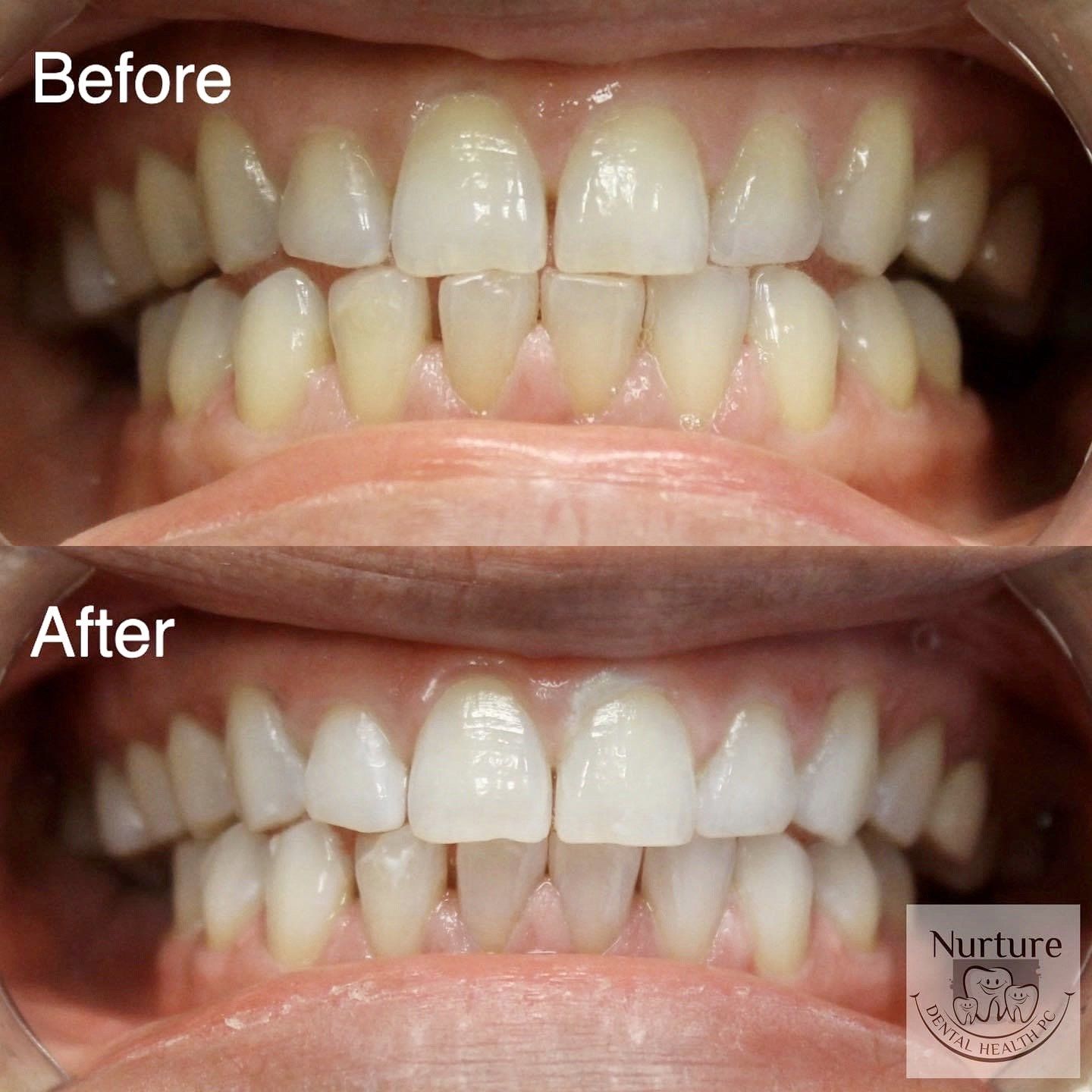 Before and after 1 hour In Office Zoom whitening results.