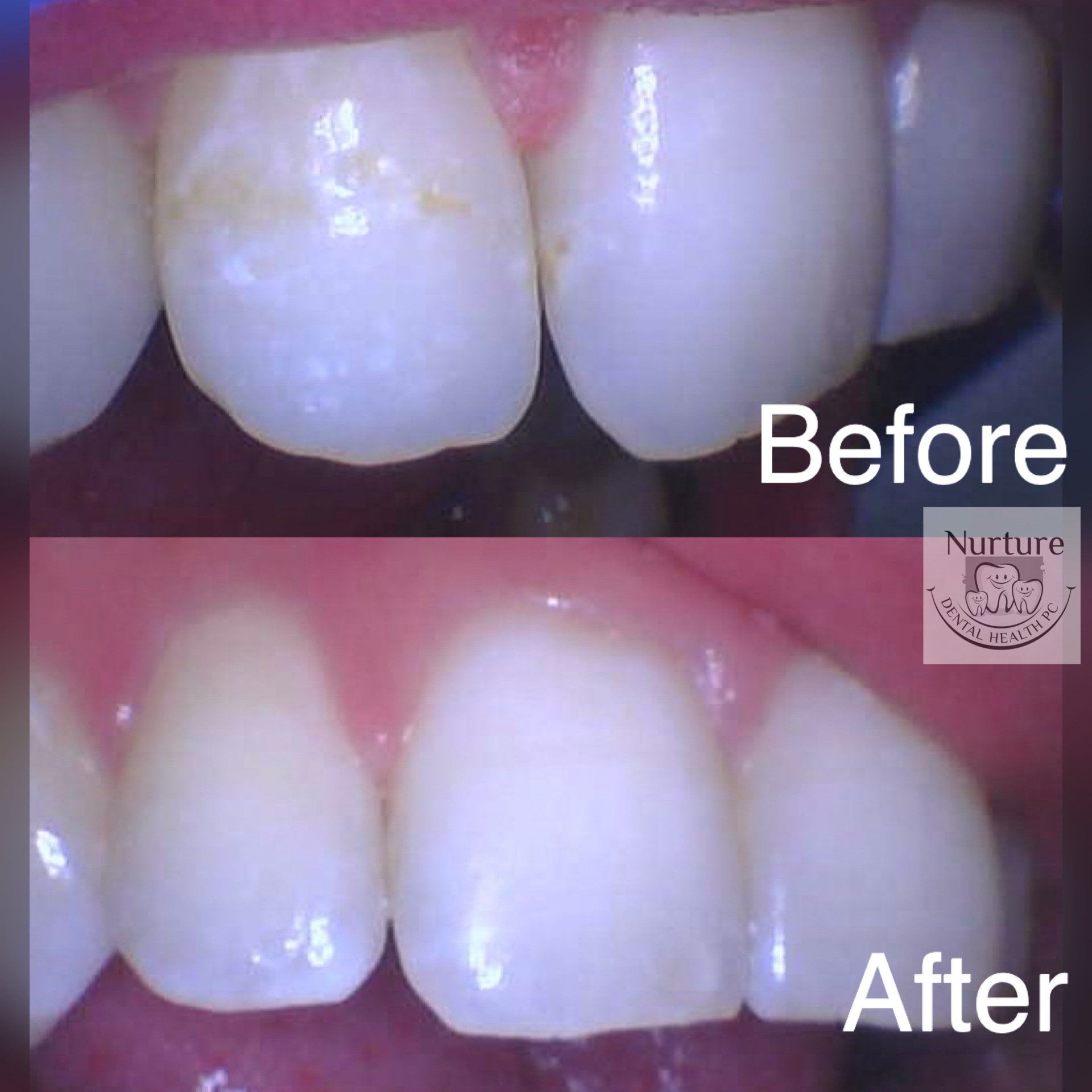 Before and after Icon Resin Infiltration treatment for white spot lesions and enamel imperfections.