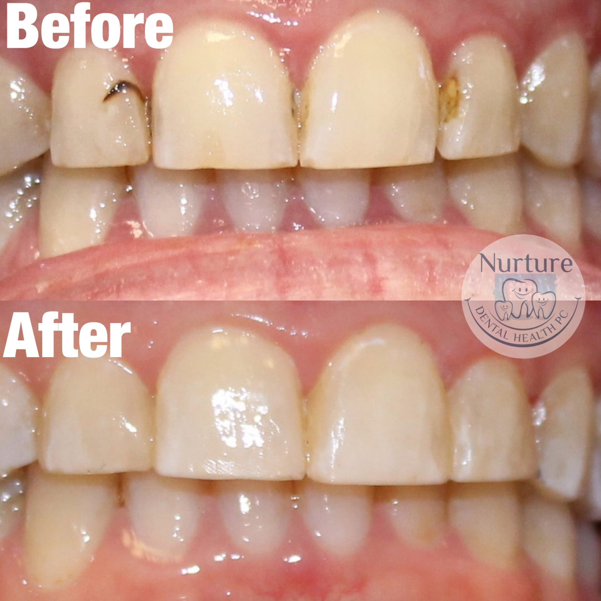 Resin Bonding in replacement of existing failing composite restorations.
