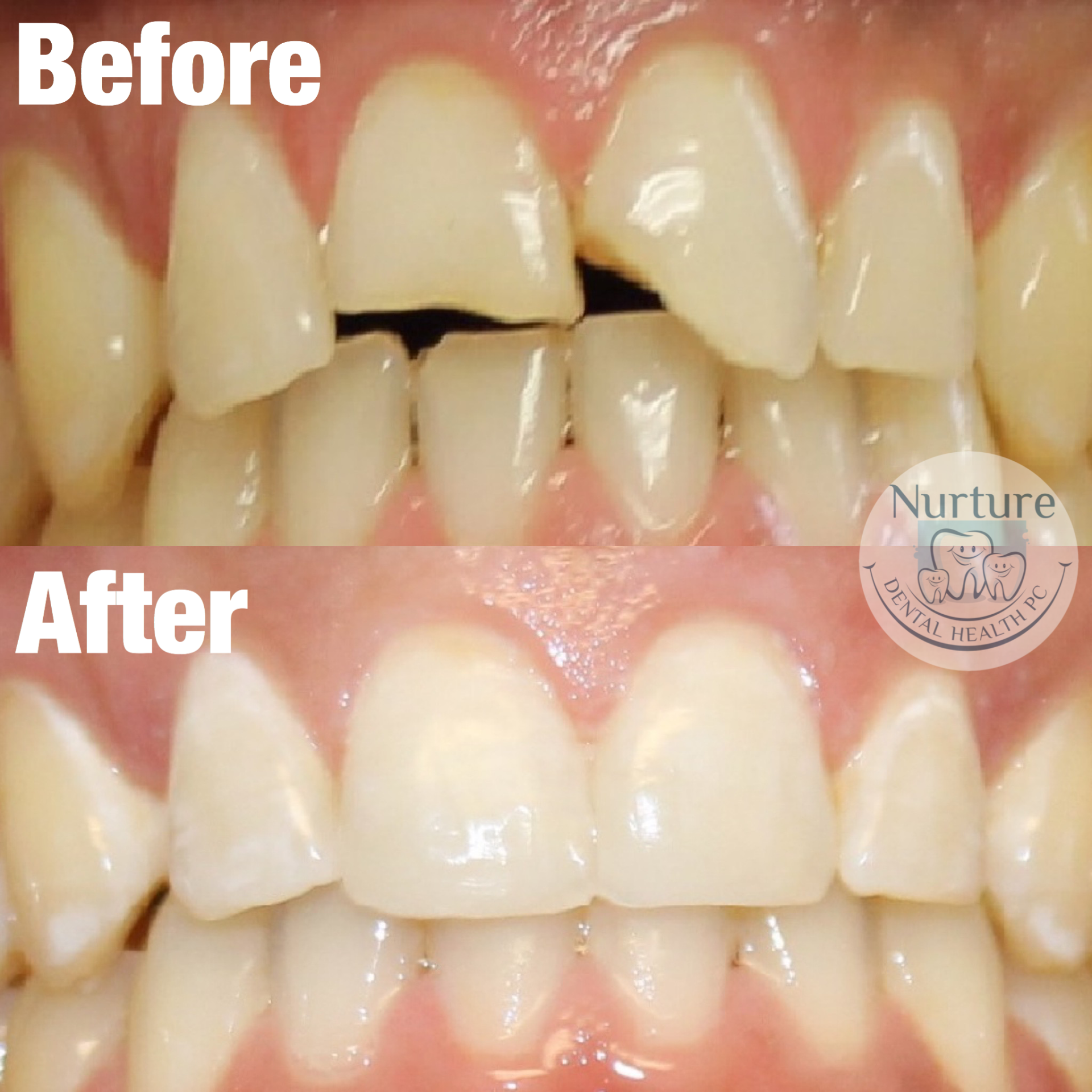 Before and after resin bonding after trauma to front teeth.
