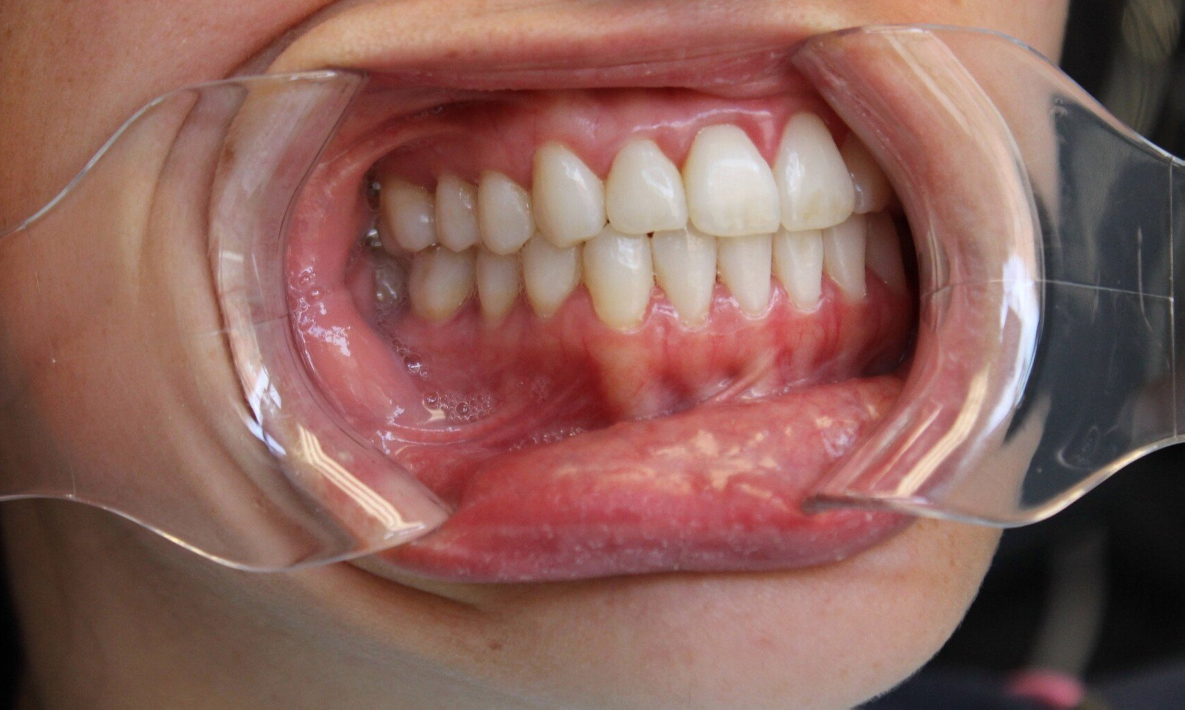 Retracted picture of teeth