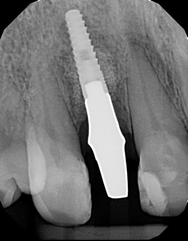 Radiograph of an implant fixture with a custom abutment that will receive a cementable crown.