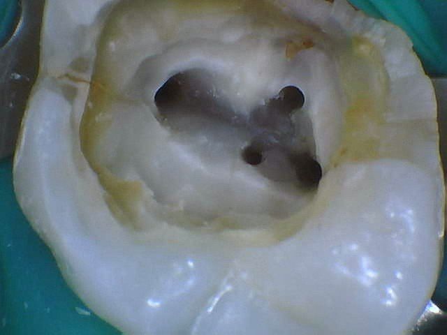 Endodontic access into a Maxillary Molar that has 4 canal spaces