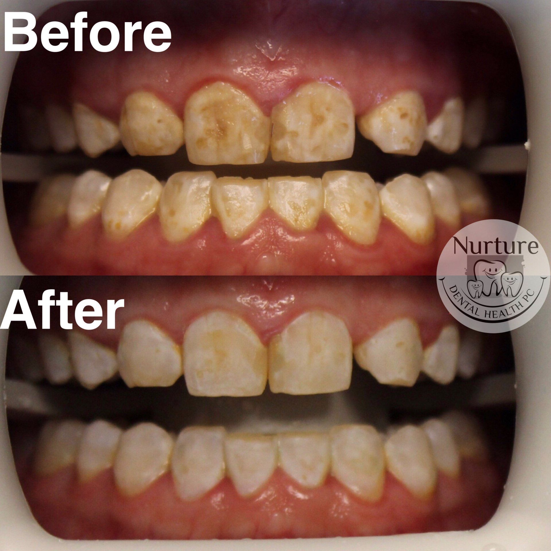 Before and After results of MI Paste treatment series for enamel fluorosis and white or brown spot lesions.