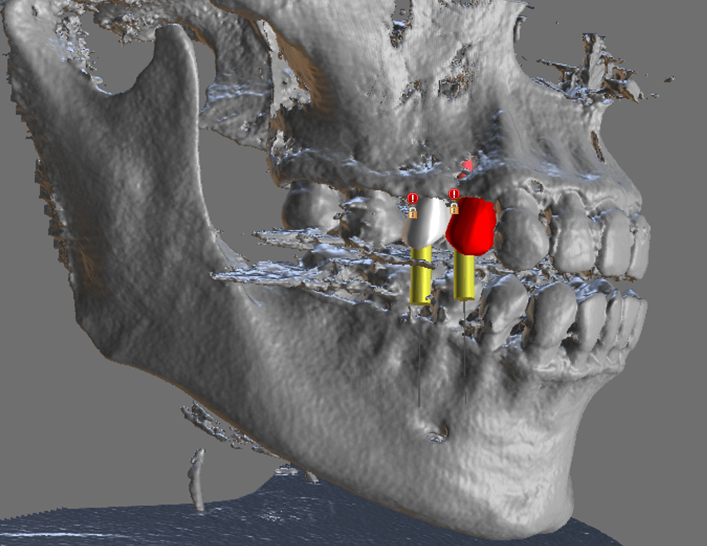 3D CBCT used in digital planning for implant fixture placement to replace two missing teeth.