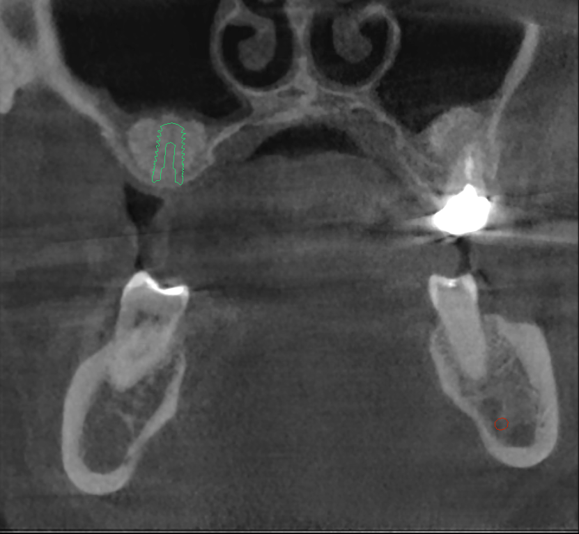 Digital planning with sinus lift, PRF, and bone graft in preparation for implant placement.