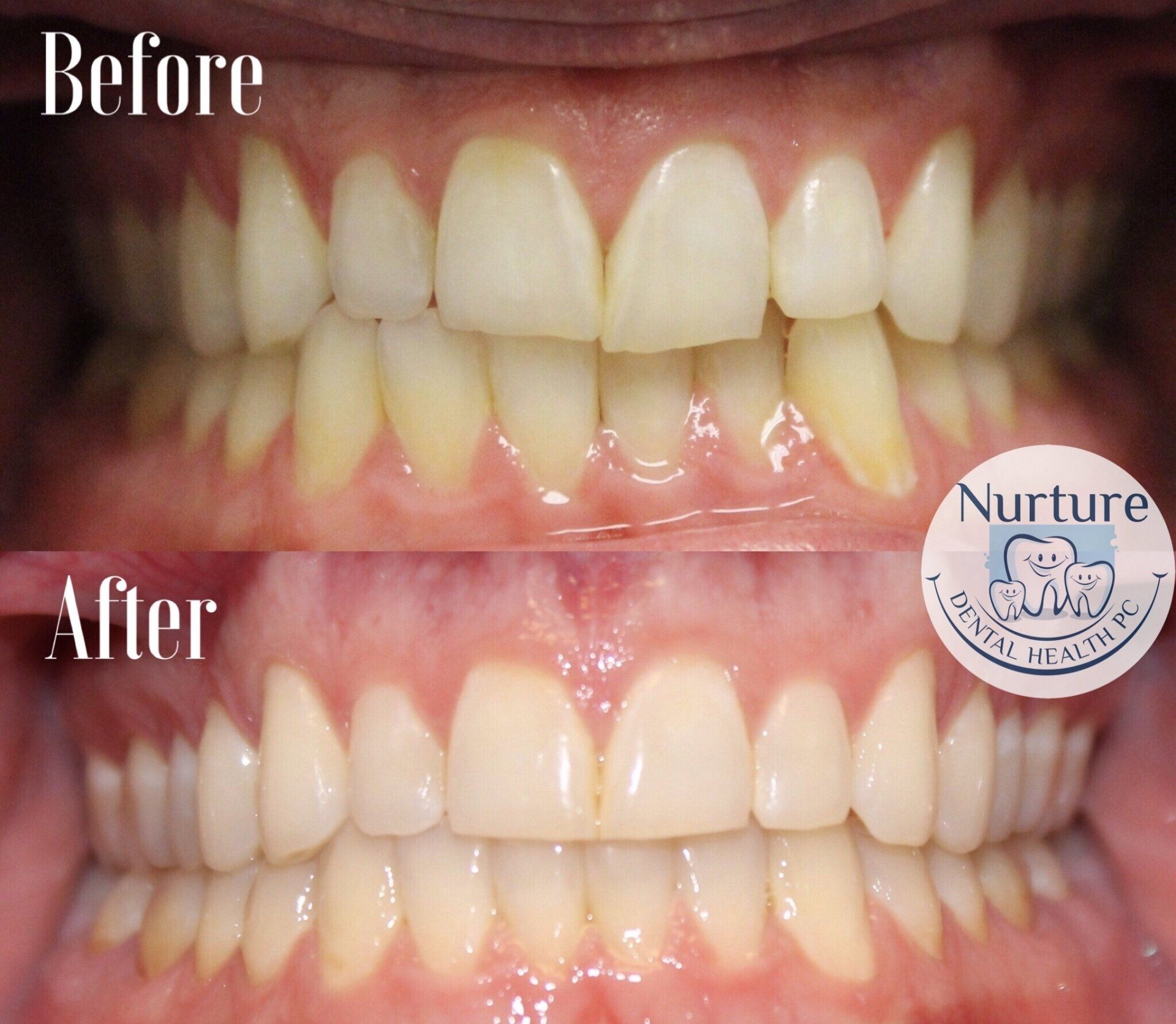 Before and after clear aligner therapy showing straighter teeth and corrected bite