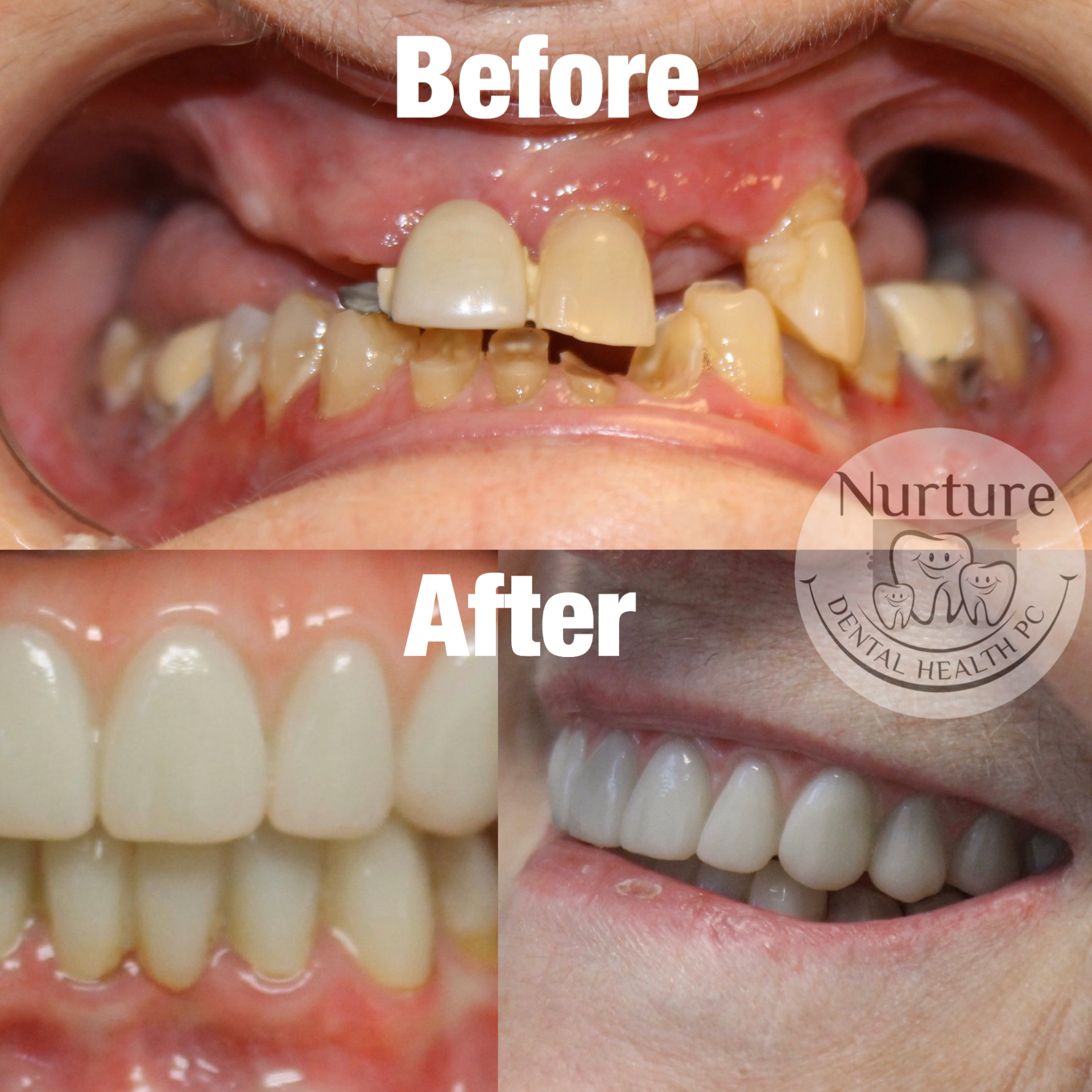 Full mouth reconstruction for missing and damaged teeth before and after.