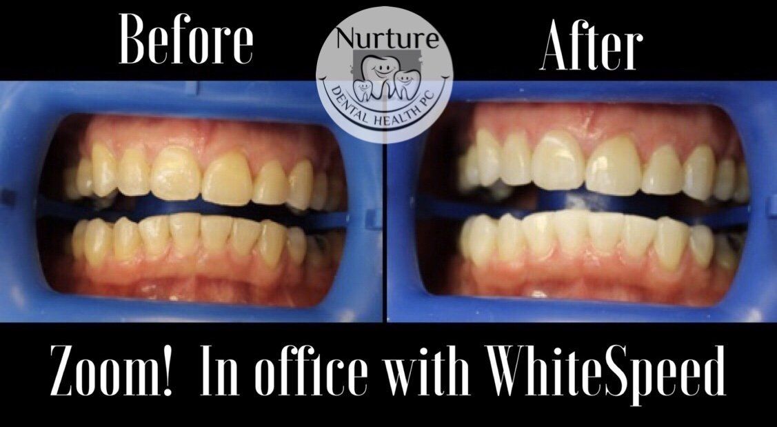 Zoom in office whitening before and after in less than one hour in our Allentown dental office.