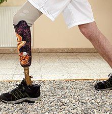 Person with amputated leg