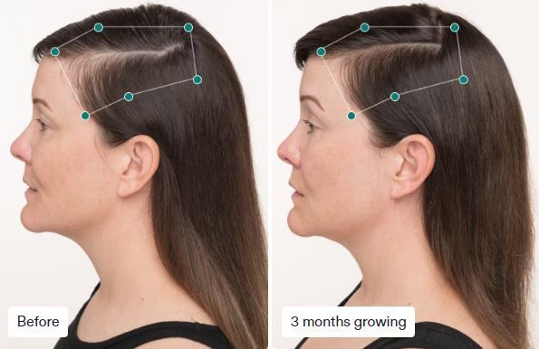 Woman's hair growth comparison: before and after 3 months. The left shows thinning, the right shows fuller hair.