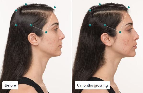 Side-by-side comparison of a woman's profile before and after 6 months of growing, showing changes in her neck and jawline.