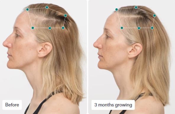 Side-by-side photos showing a woman's hairline before and after 3 months of hair growth.