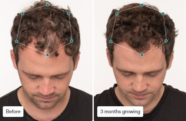 Before and after photos of a man with hair loss, showing improvement after 3 months.