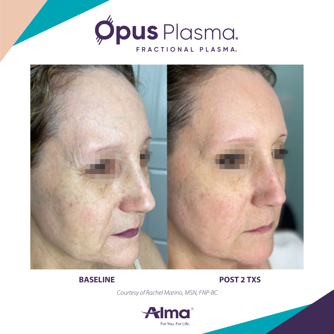 A before and after photo of a woman 's face for opus plasma
