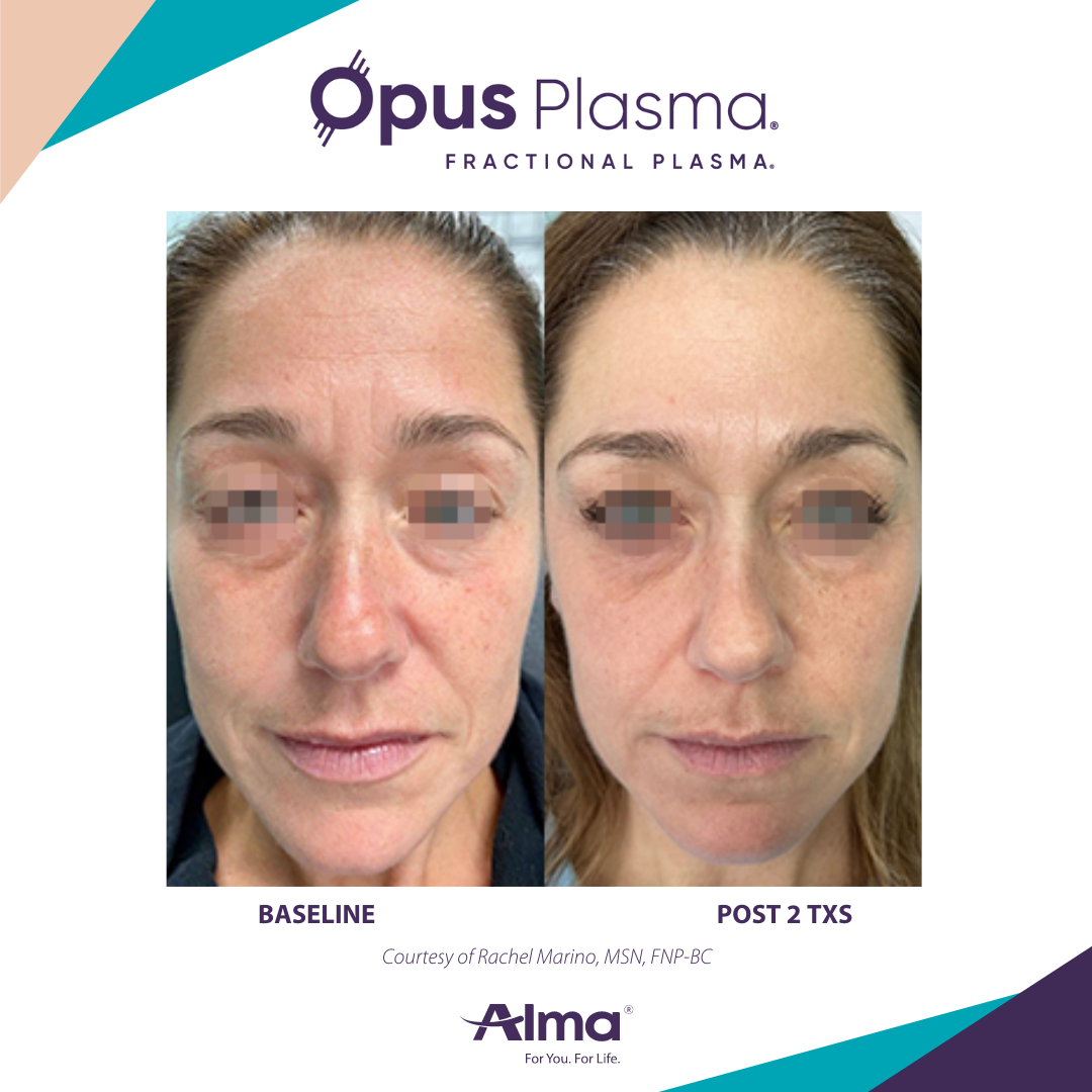A before and after photo of a woman 's face for opus plasma