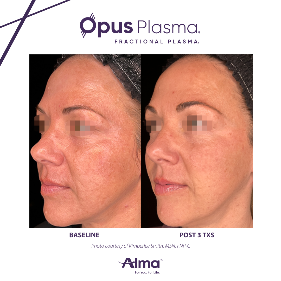 A before and after photo of a woman 's face for opus plasma