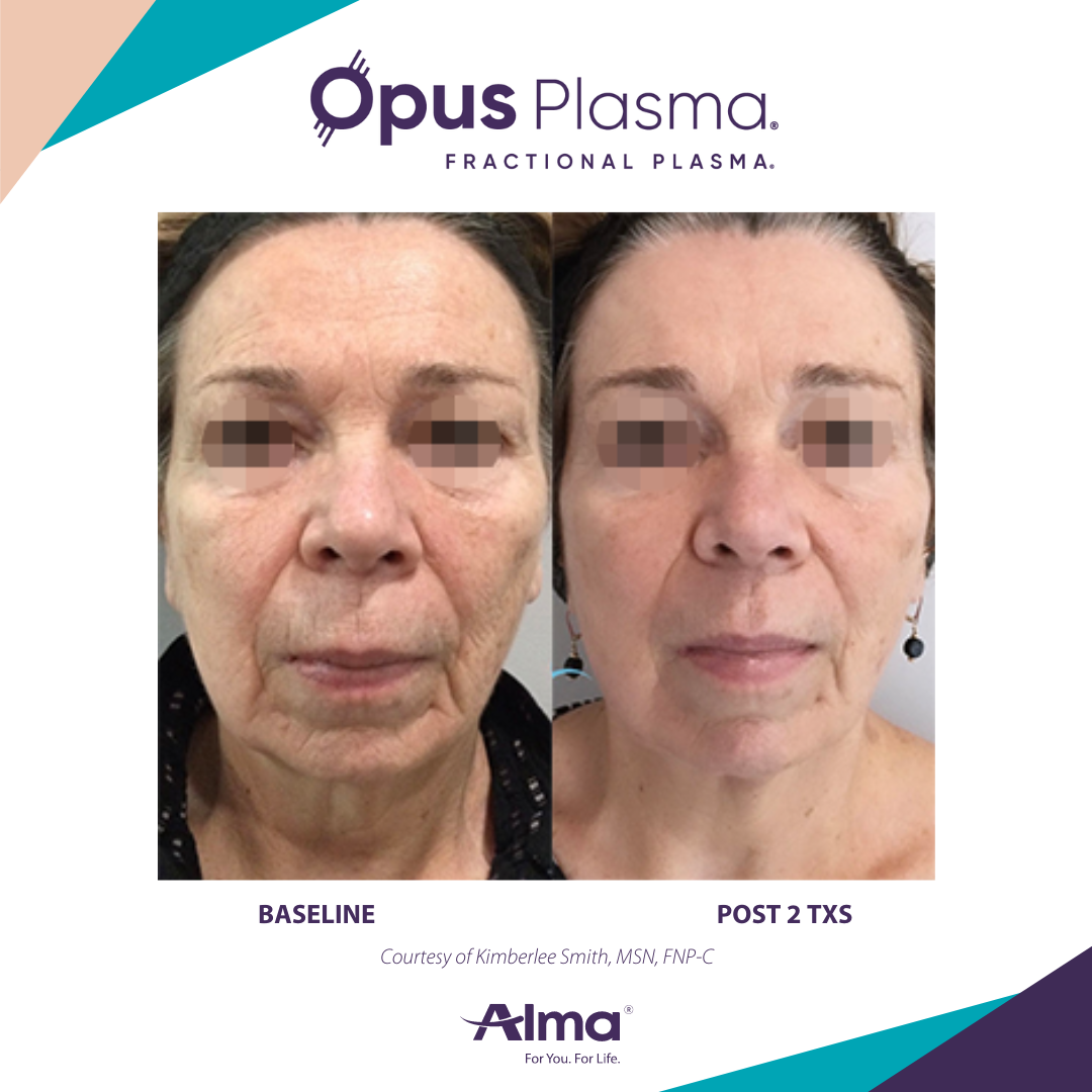 A before and after photo of a woman 's face for opus plasma