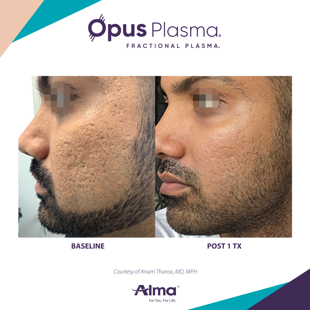 A man with a beard is shown before and after using opus plasma