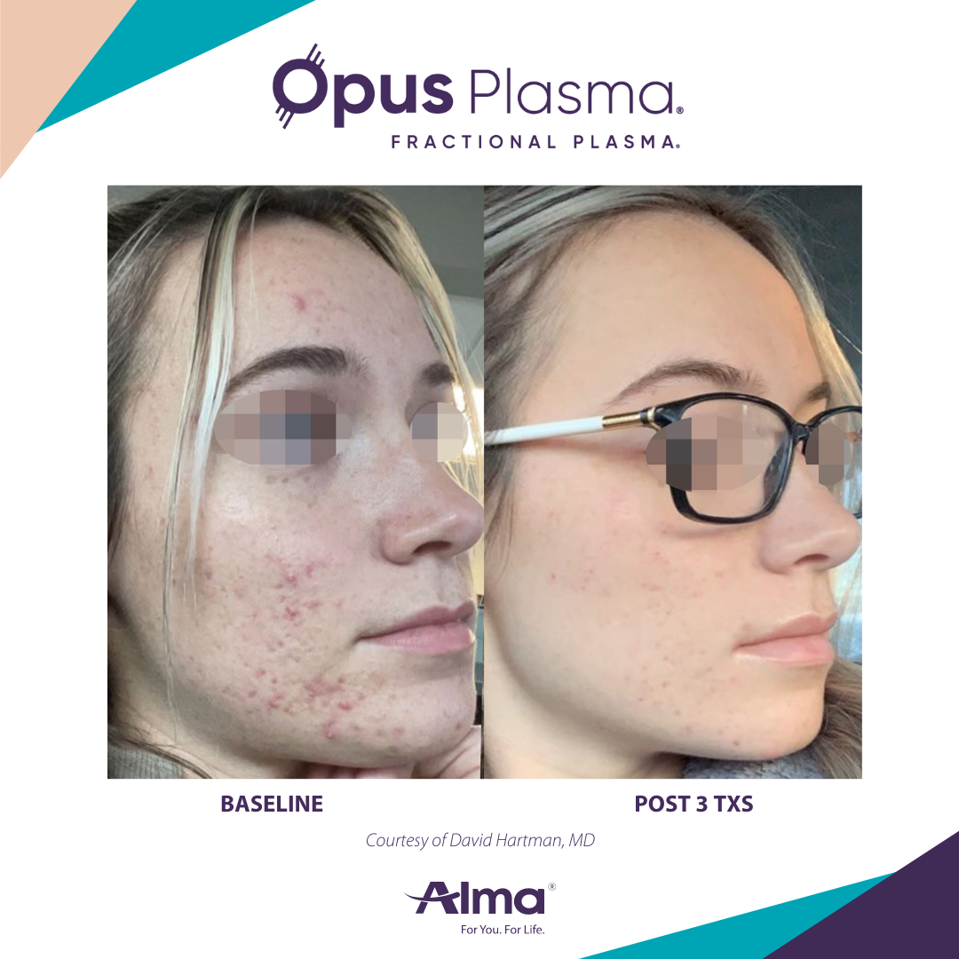 A before and after photo of a woman 's face for opus plasma