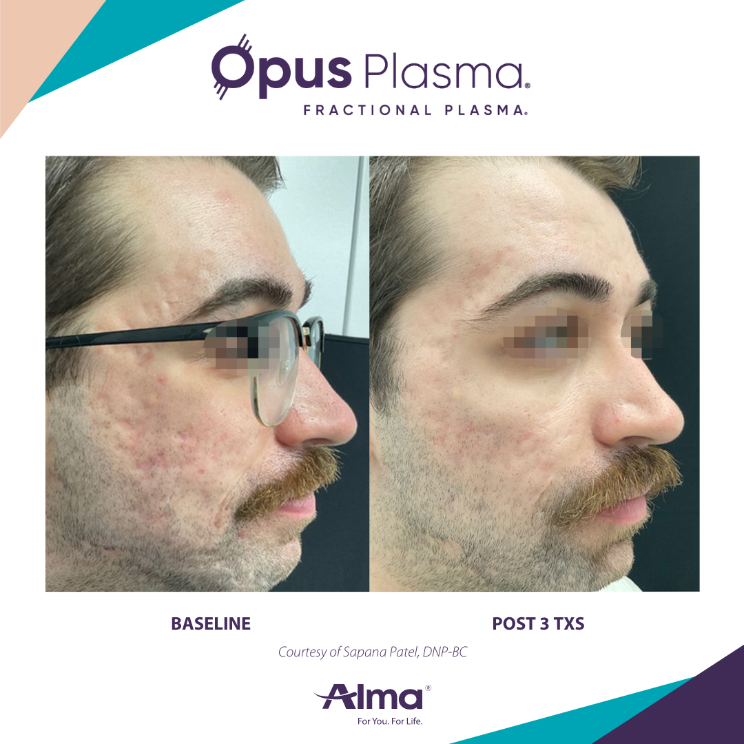 A man with glasses and a mustache is shown before and after using opus plasma