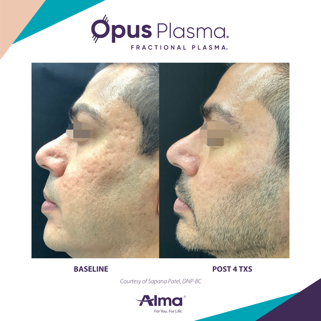 A before and after photo of a man 's face for opus plasma