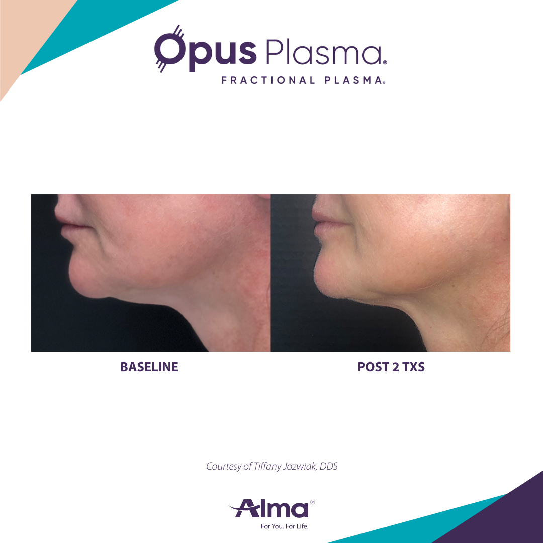 A before and after picture of a woman 's face with opus plasma written on the bottom