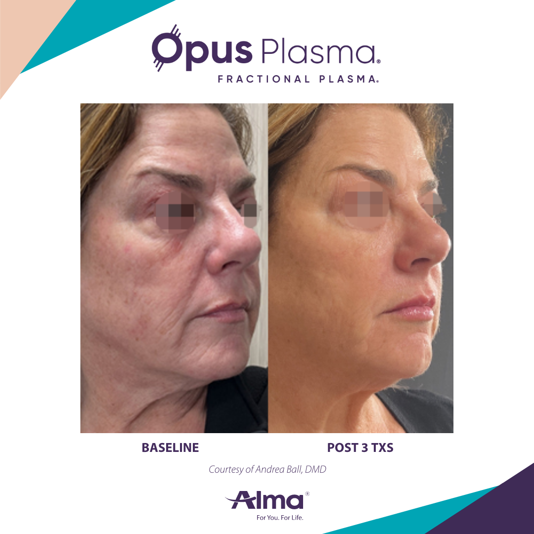 A before and after photo of a woman 's face for opus plasma